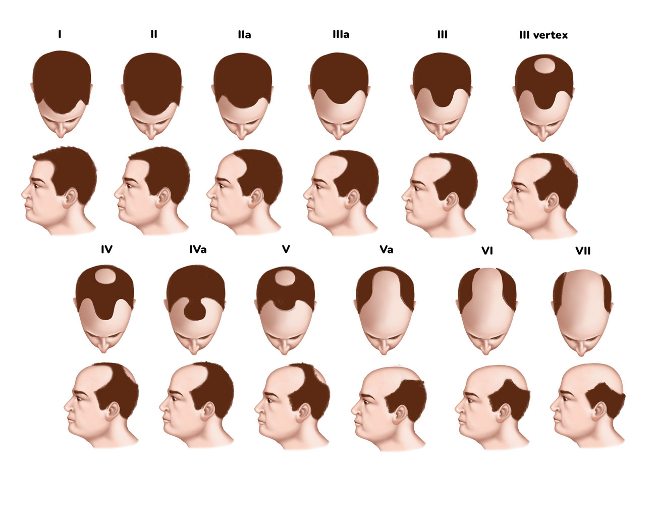 Conhe A Os Graus Da Calv Cie Masculina Escala De Norwood Hamilton