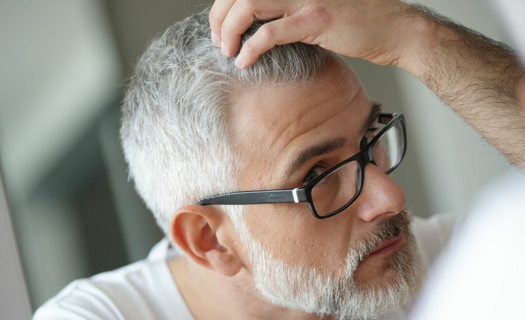 Quem tem cabelo branco pode fazer transplante capilar?